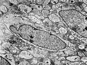 F,8y. | fibrillary astrocytoma F,8y. | fibrillary astrocytoma